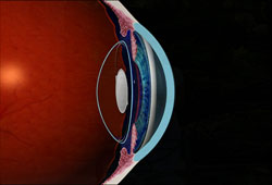 Cataract surgery cataract surgery