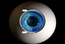 astigmatism astigmatism